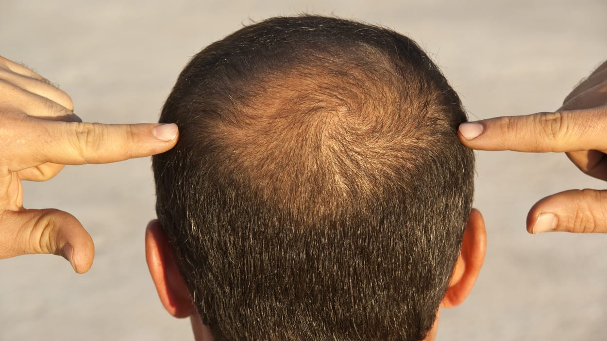 hair transplant